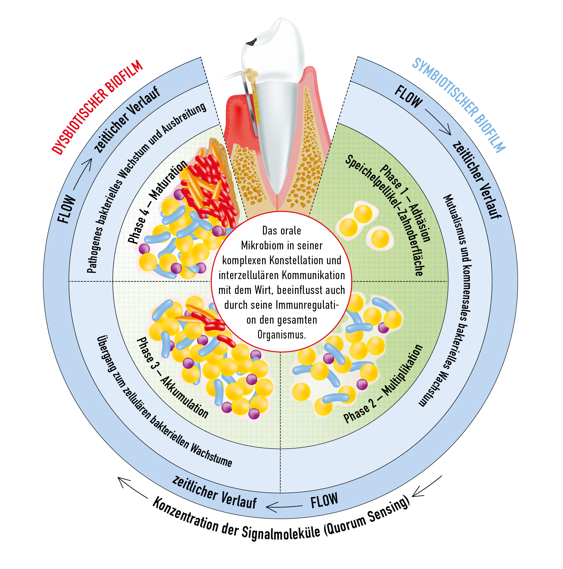 Abb. 1: Phasenverlauf einer pathologischen Biofilm-Entwicklung: Der Übergang in ein dysbiotisches Mikrobiom erfolgt nur bei Vorliegen von Risikofaktoren. Dazu gehören eine schlechte Mundhygiene, Rauch