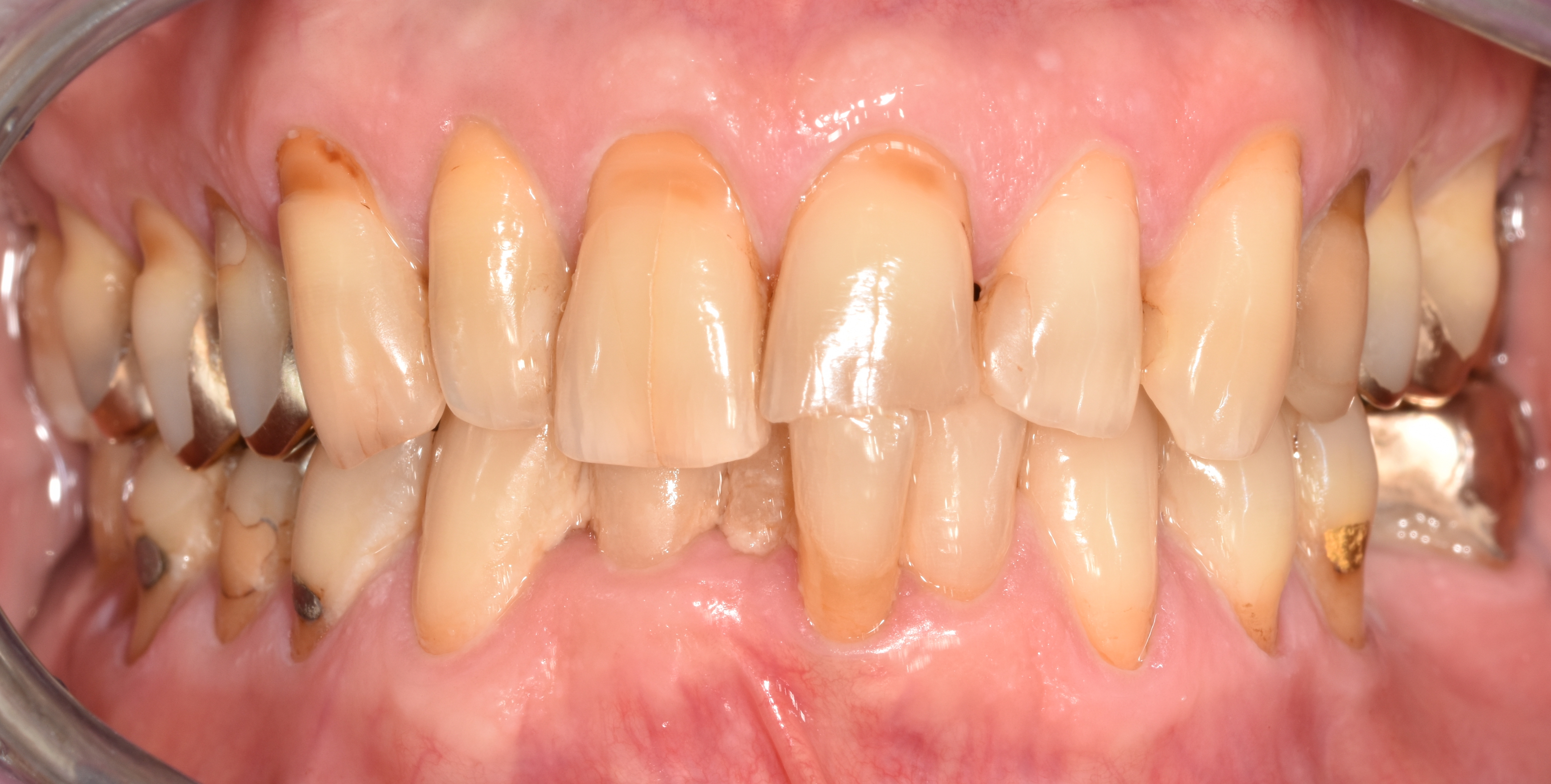 Abb. 1a: Ansicht von frontal in habitueller Okklusion