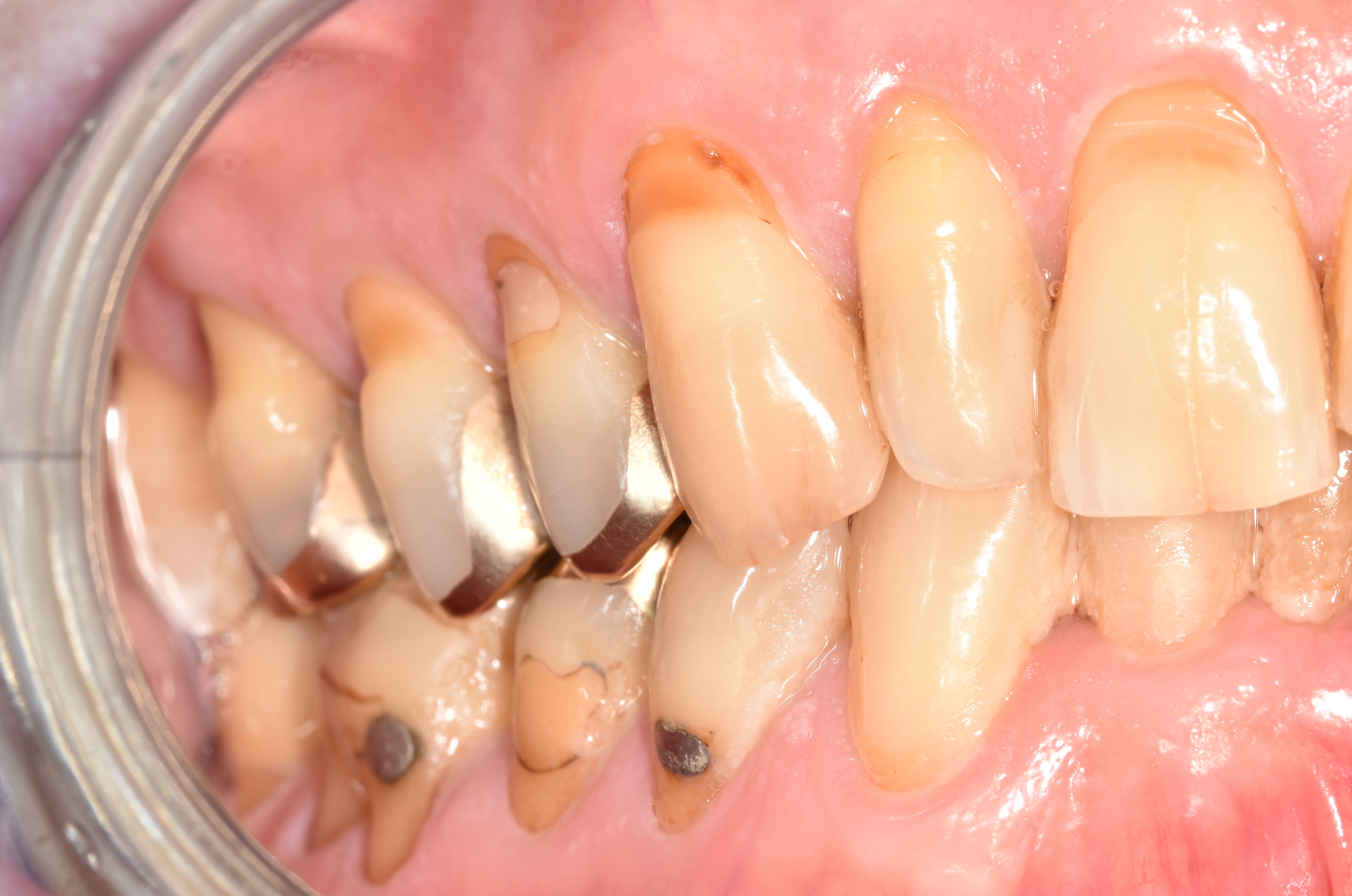 Abb. 1b: Seitenansicht rechts in habitueller Okklusion