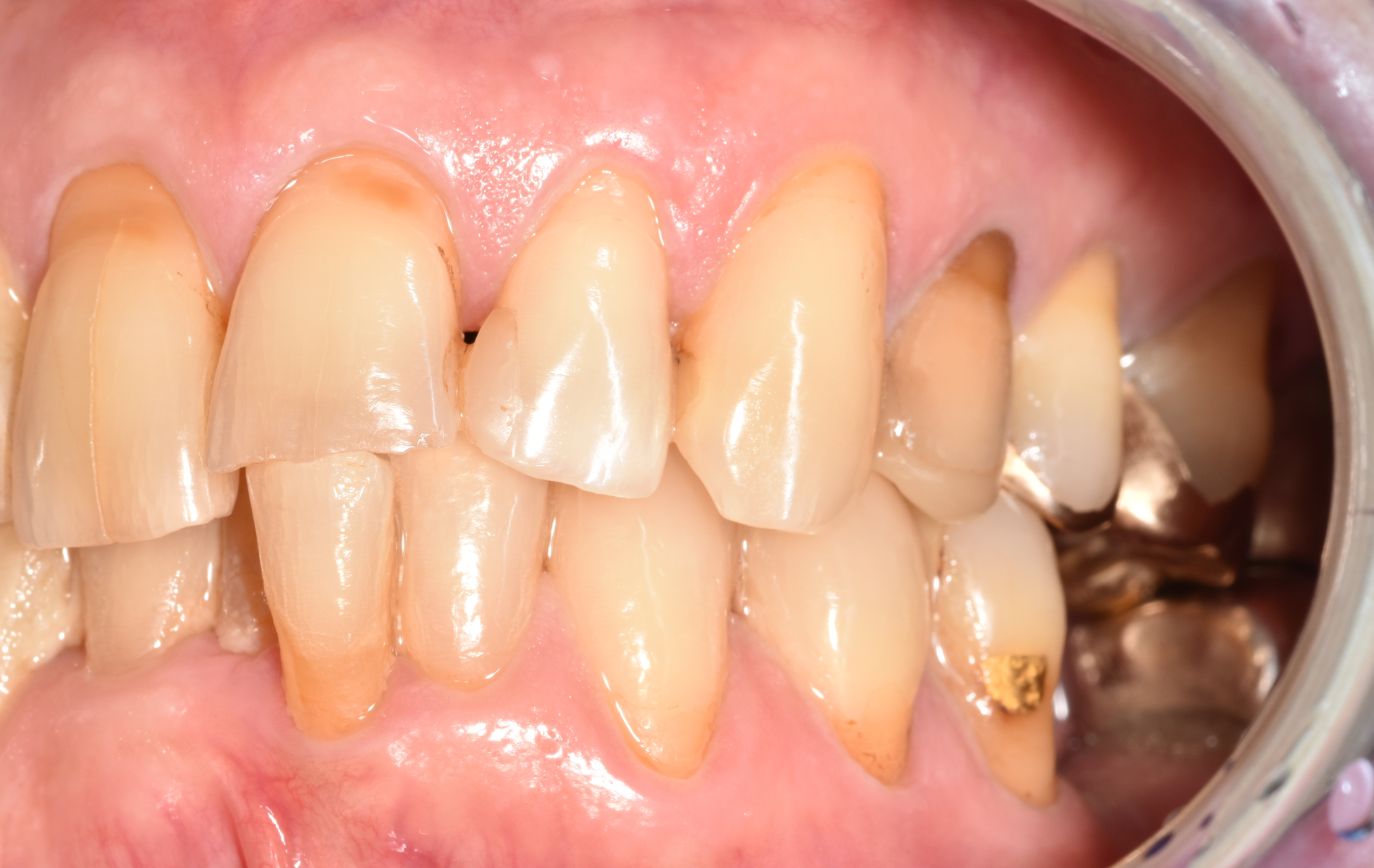 Abb. 1c: Seitenansicht links in habitueller Okklusion