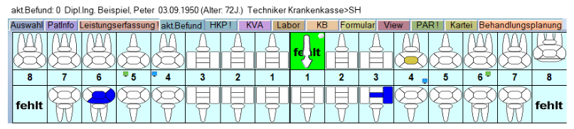 Implantatgetragene Krone Abb. 2
